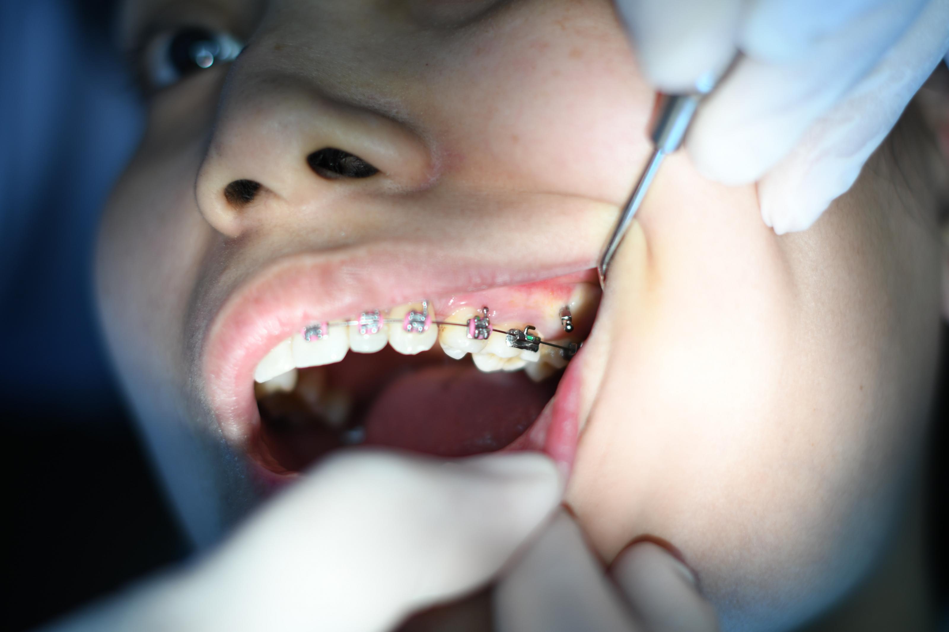 Mesa Affordable Dentist. Benefits Of Wearing Braces