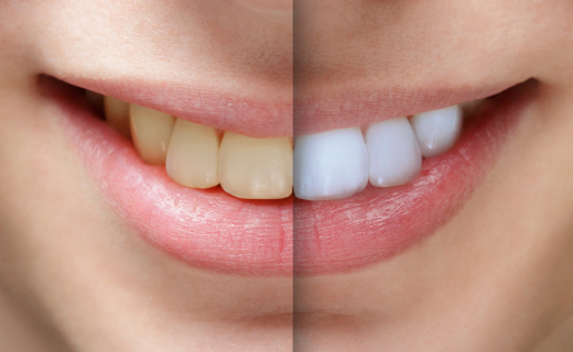 Chandler Affordable Dentist. How Does Teeth Whitening Work?